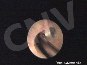 artroscopia2_3