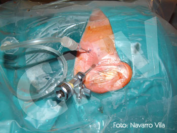 artroscopia_3