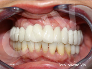 aspecto-de-la-oclusion-final-tras-la-rehabilitacion-en-porcelana
