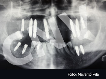colocacion-de-7-implantes