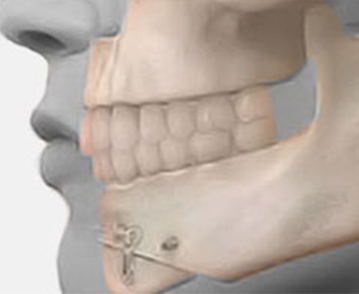 Congreso Nacional de Cirugía BucoMaxilofacial Boliviana