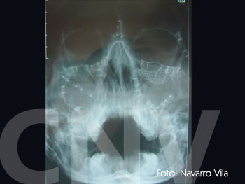 control-fractura-de-tercio-medio-facial