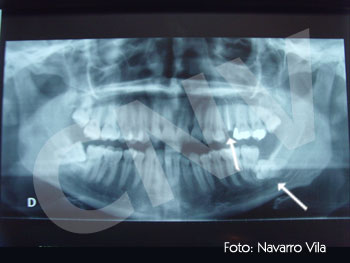 cordales-y-resto-radicular_1
