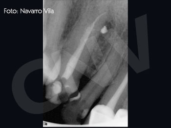 endo2