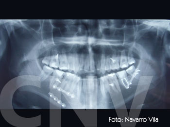 fijacion-con-miniplacas-de-los-focos-de-fractura