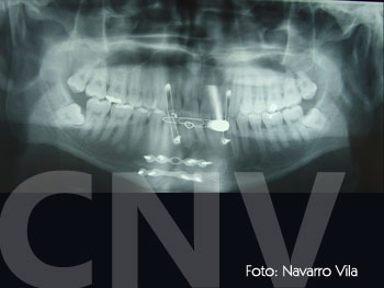 fijacion-miniplacas-del-foco-de-fractura