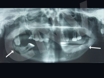 fractura-bilateral-de-mandibula_2