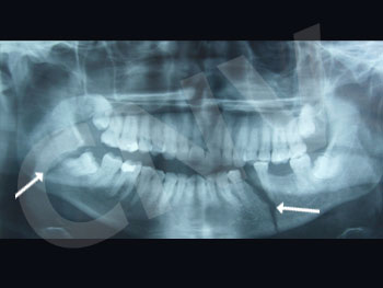fractura-doble-de-mandibula_2