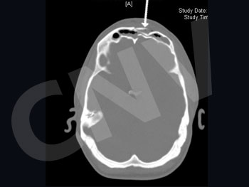 fractura-frontal_2