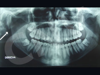fractura-subcondilea-derecha_2