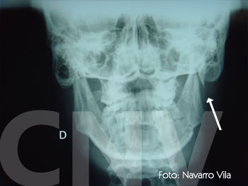 fractura-subcondilea
