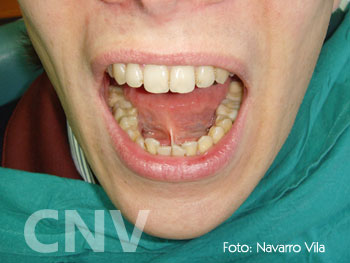 frenillo-lingual