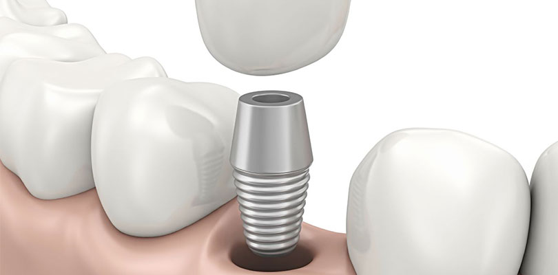 implantes-dentales
