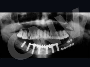 implantes-osteointegrados_1