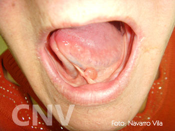 mucocele