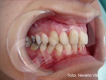 oclusion-final2_1