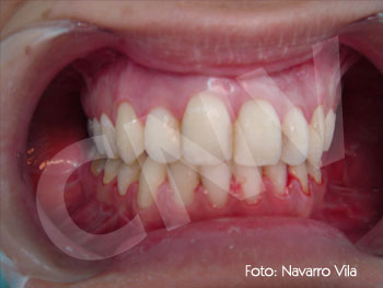 oclusion-final_2