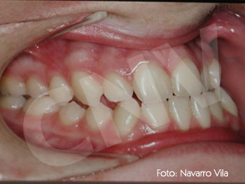 oclusion-inicial