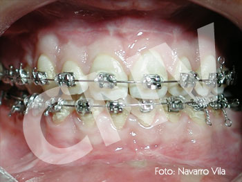 oclusion-postquirurgica_11