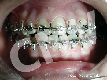 oclusion-prequirurgica-1