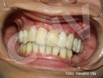 oclusion-tras-la-carga-inmediata