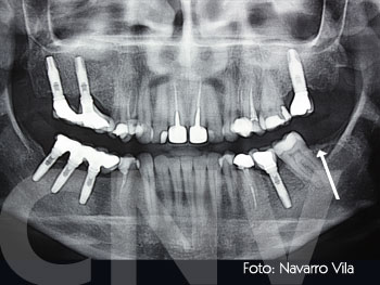 opg-con-implantes-en-los-cuatro-cuadrantes1