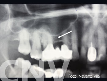 opg-donde-se-visualiza-la-atrofia-del-maxilar-superior-derecho