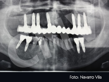 ortopantomografia-final-con-la-rehabilitacion-en-porcelana-superior-e-inferior