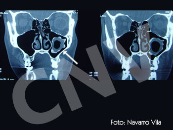 quiste-odontogenico-intramaxilar_1