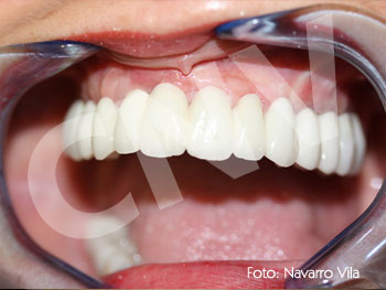 rehabilitacion-final-en-porcelana