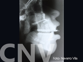rx-lateral