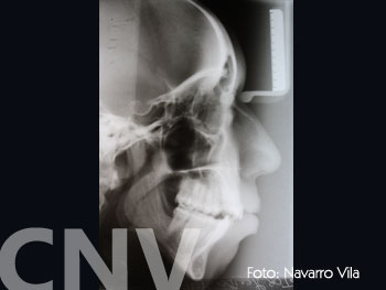 rx-lateral11